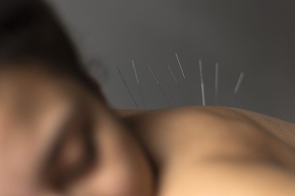 Mujer durante un tratamiento de acupuntura en Lahera Salud
